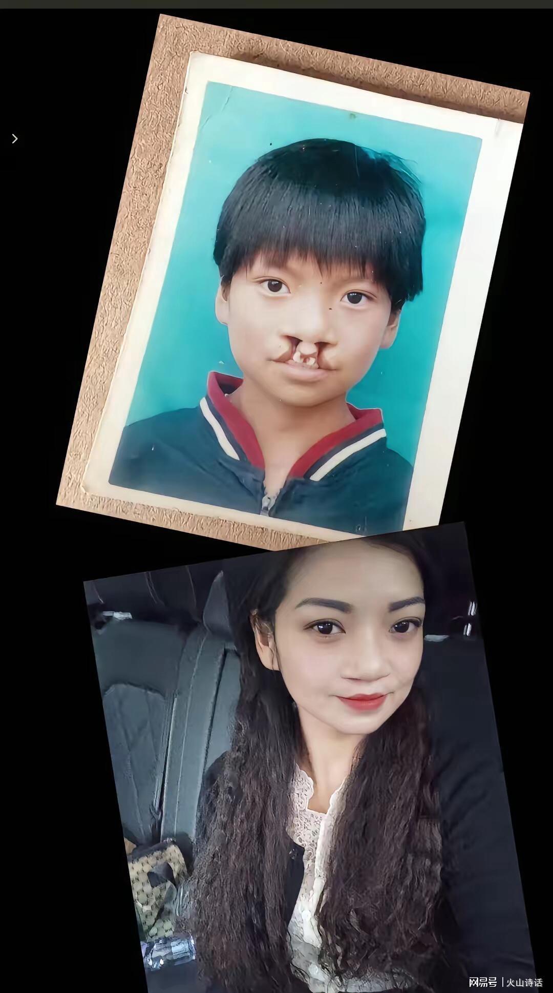 龙8国际app下载-震惊!为声援李亚鹏,一漂亮女孩坦然展示自己唇腭裂手术前后照片
